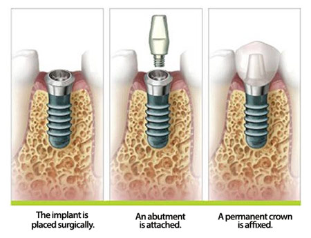 The dental implant process shown in this diagram shows the steps taken to rebuild a tooth.