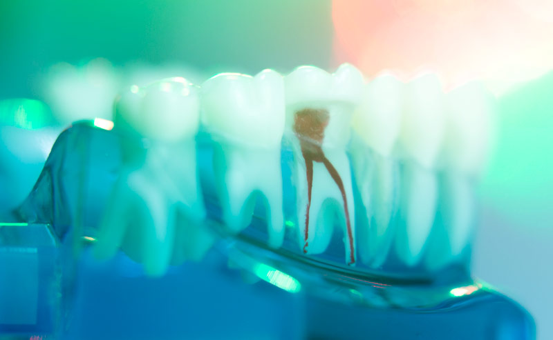 root canal treatment therapy sw calgary
